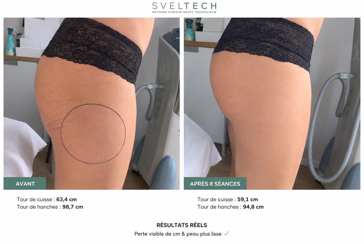 Résultat avant / après SvelTech — cuisses